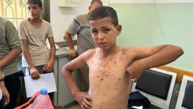 أمراض جلدية خطيرة بين أطفال غزة