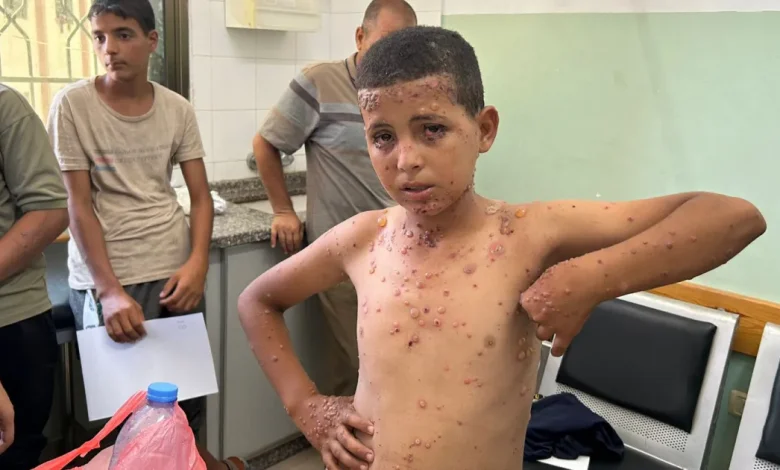 أمراض جلدية خطيرة بين أطفال غزة